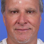 Facelift Before & After Patient #9985