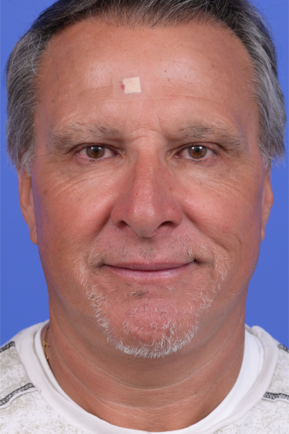 Facelift Before & After Patient #9985