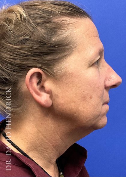 Brow Lift Before & After Patient #9983