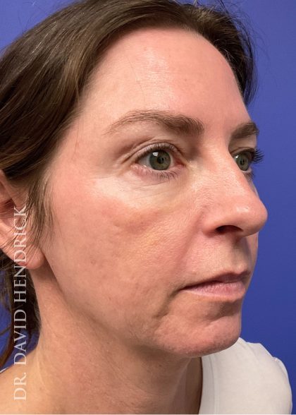 Facelift Before & After Patient #9984