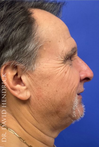 Facelift Before & After Patient #9985