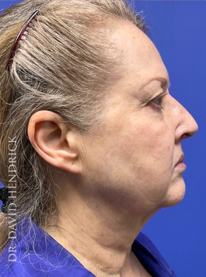 Facelift Before & After Patient #9982