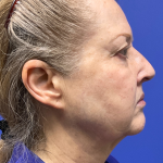Facelift Before & After Patient #9982