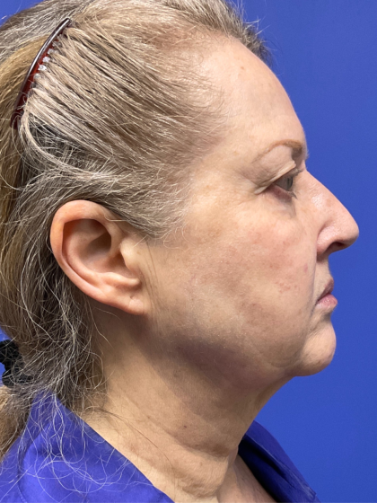 Facelift Before & After Patient #9982