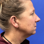 Brow Lift Before & After Patient #9983