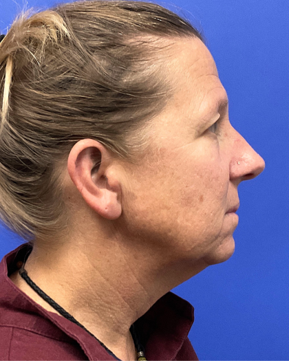 Brow Lift Before & After Patient #9983