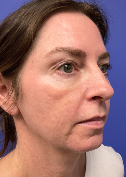 Facelift Before & After Patient #9984
