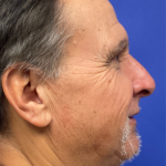 Facelift Before & After Patient #9985