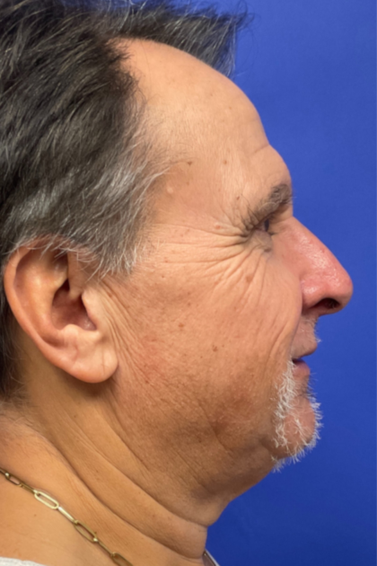 Facelift Before & After Patient #9985