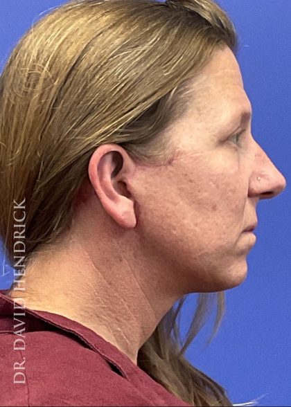 Brow Lift Before & After Patient #9983