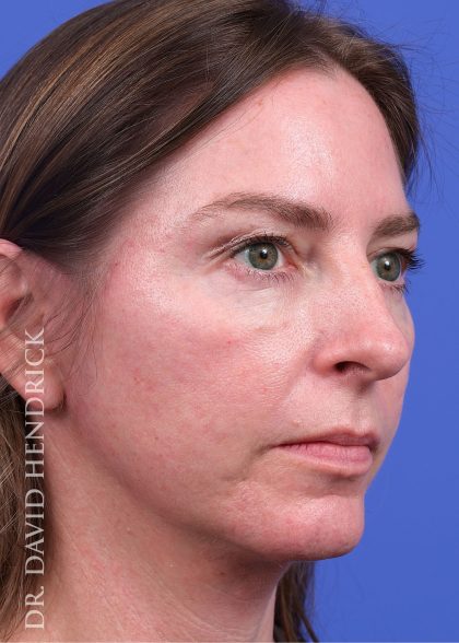 Facelift Before & After Patient #9984