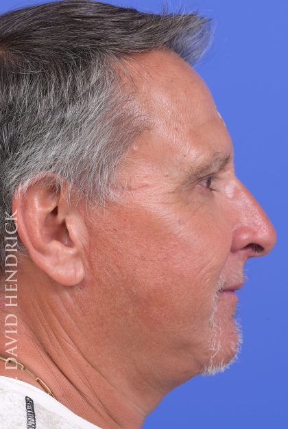 Facelift Before & After Patient #9985