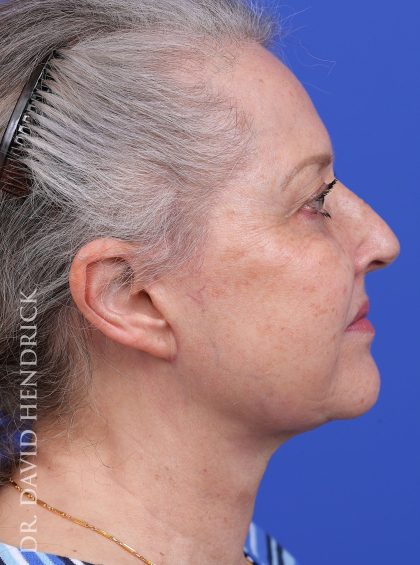 Facelift Before & After Patient #9982