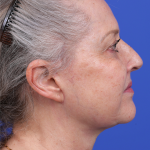 Facelift Before & After Patient #9982