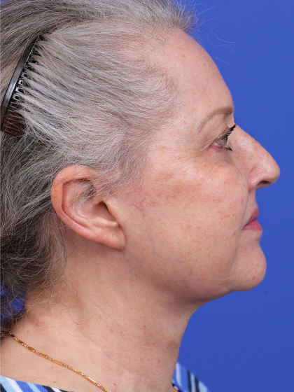Facelift Before & After Patient #9982