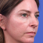 Facelift Before & After Patient #9984