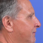 Facelift Before & After Patient #9985