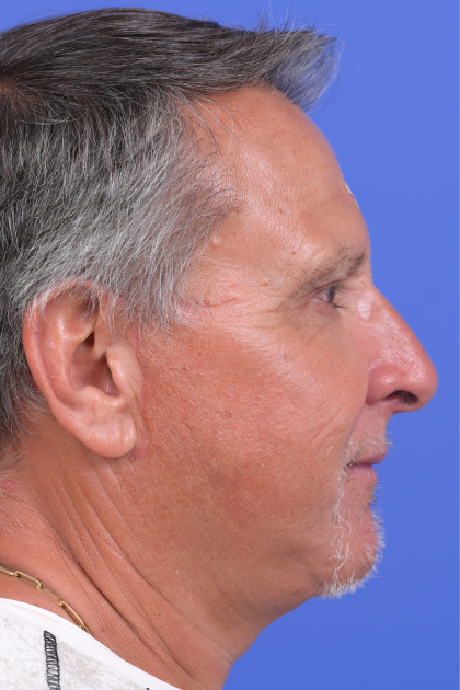 Facelift Before & After Patient #9985