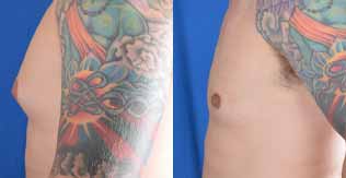 before after