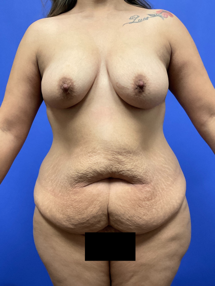 Mommy Makeover Before & After Patient #10560