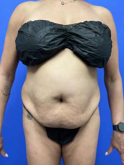 Brazilian Butt Lift Before & After Patient #10500