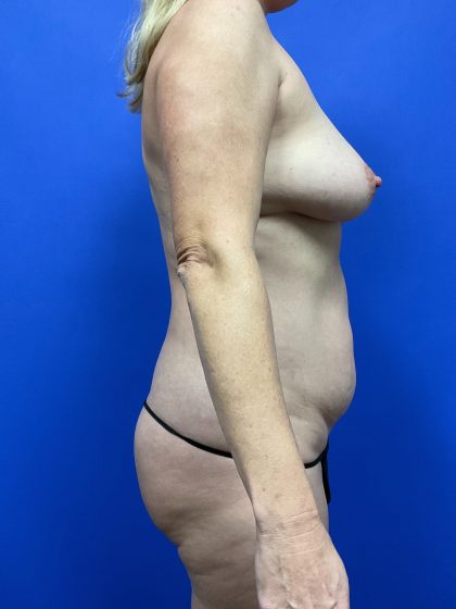 VASER Hi Def Liposuction Before & After Patient #10501