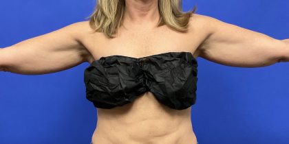VASER Hi-Def Arm Liposuction Before & After Patient #10504
