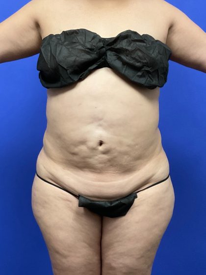 Brazilian Butt Lift Before & After Patient #10574