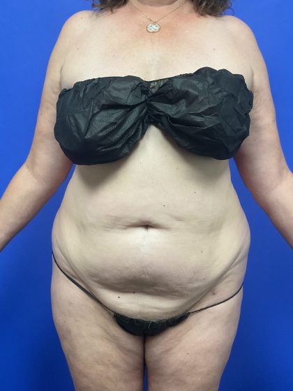Tummy Tuck - Extended Before & After Patient #10576