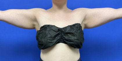Arm Lift Before & After Patient #10466