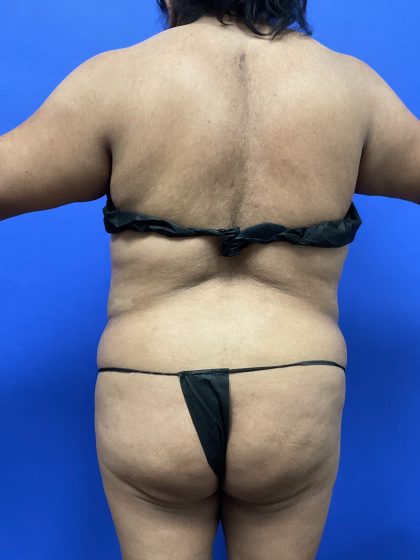 Back Liposuction Before & After Patient #10554