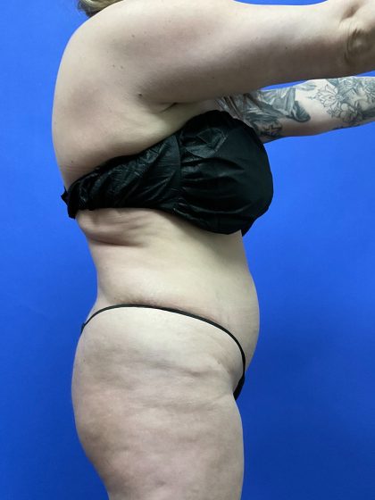 VASER Hi Def Liposuction Before & After Patient #10555