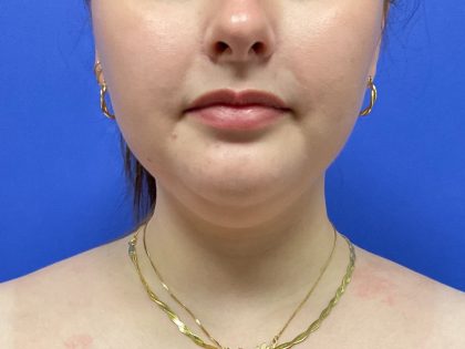 Chin Liposuction Before & After Patient #10557