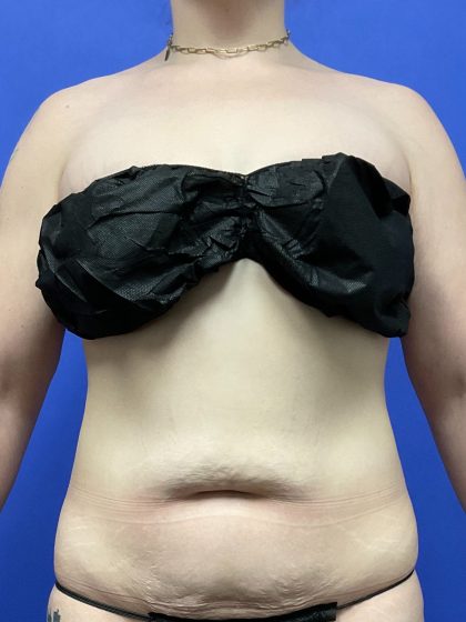 Tummy Tuck Before & After Patient #10467