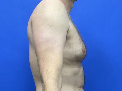 Standard Liposuction Before & After Patient #10468
