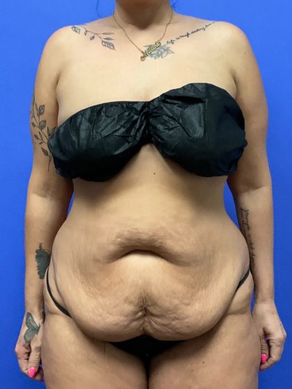 Tummy Tuck - Extended Before & After Patient #10464