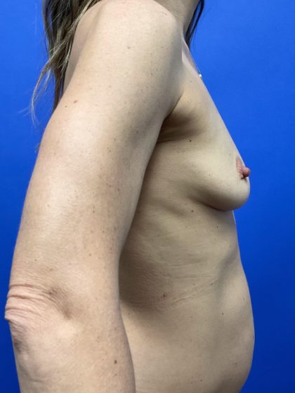 Breast Augmentation Before & After Patient #10495