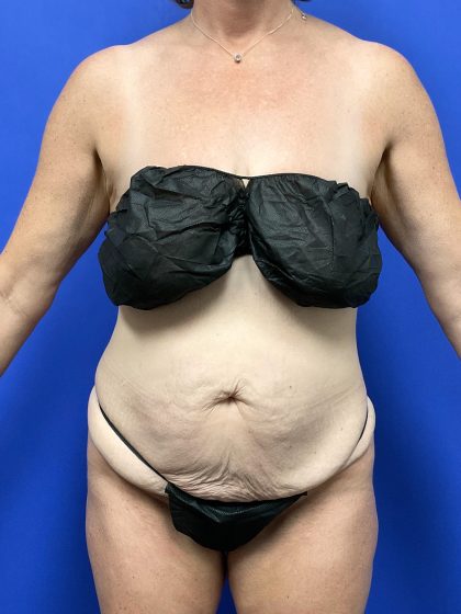 Tummy Tuck - Extended Before & After Patient #10499
