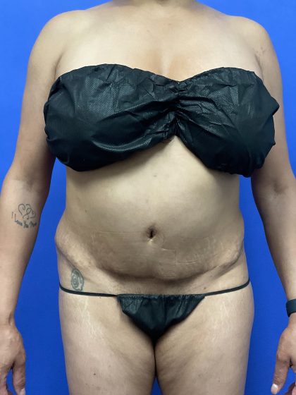 Brazilian Butt Lift Before & After Patient #10500