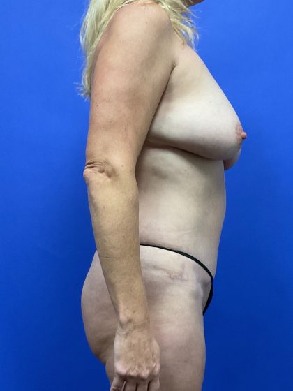 VASER Hi Def Liposuction Before & After Patient #10501