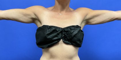 VASER Hi Def Liposuction Before & After Patient #10502