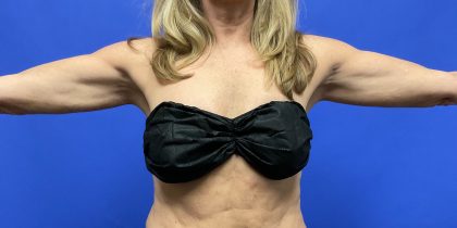 VASER Hi-Def Arm Liposuction Before & After Patient #10504