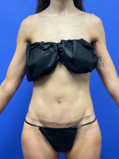 Tummy Tuck Before & After Patient #10553