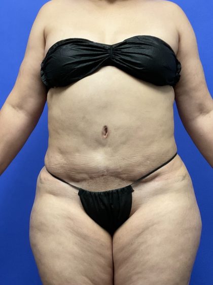 Brazilian Butt Lift Before & After Patient #10574