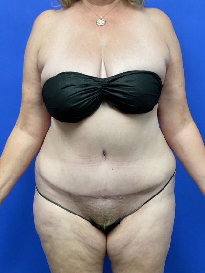 Tummy Tuck - Extended Before & After Patient #10576