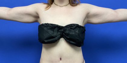 Arm Lift Before & After Patient #10466