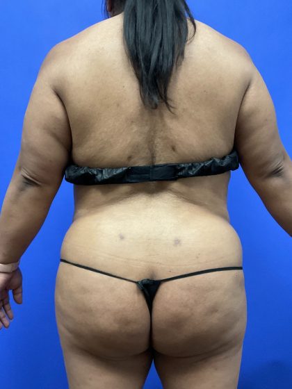 Back Liposuction Before & After Patient #10554