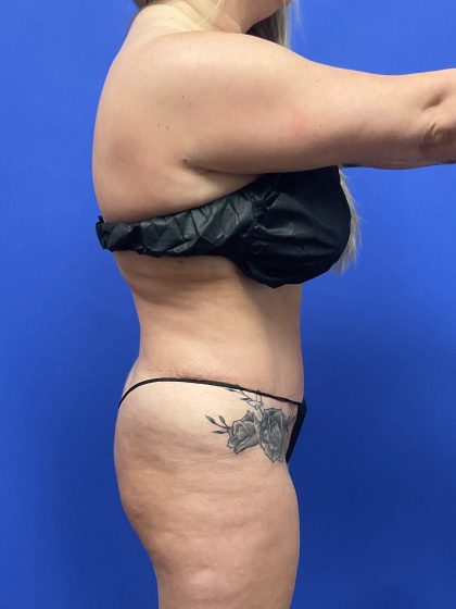 VASER Hi Def Liposuction Before & After Patient #10555