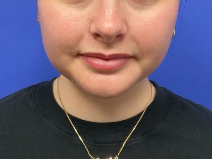 Chin Liposuction Before & After Patient #10557