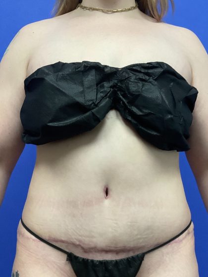 Tummy Tuck Before & After Patient #10467